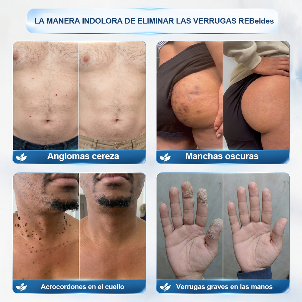 Tienda oficial de la marca | ✅💎 Purelora® Borrador de verrugas y manchas de 7 días (Aplicador roll-on: sin dolor ni cicatrices)