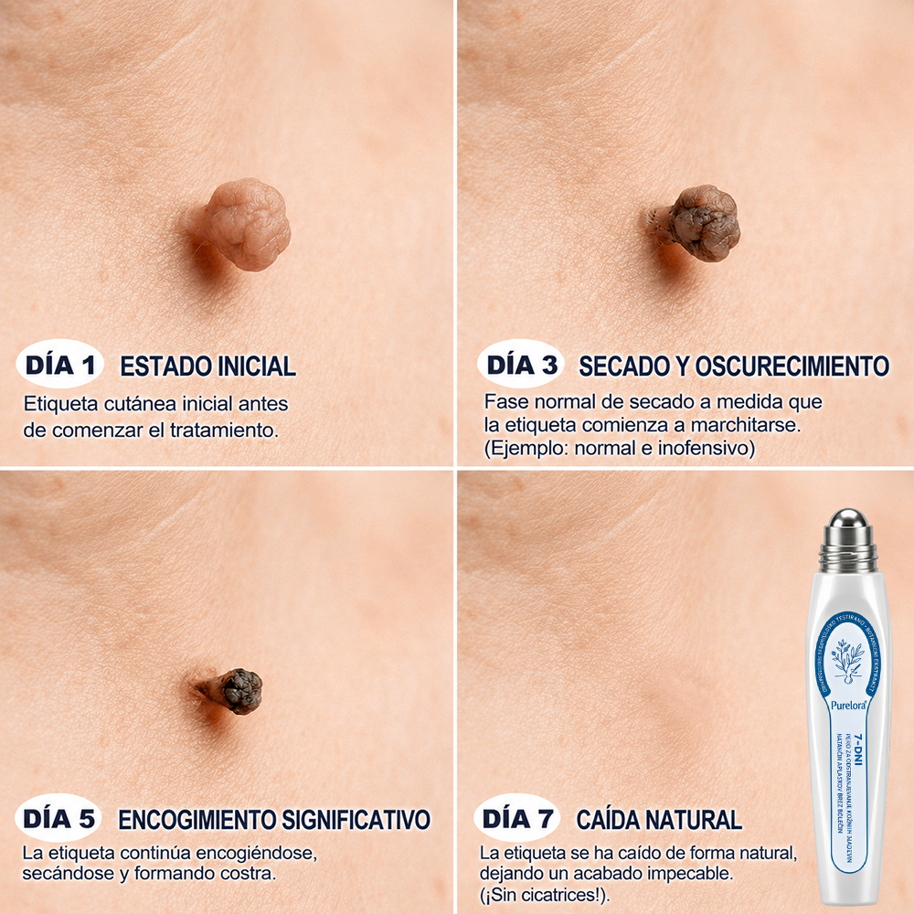 Tienda oficial de la marca | ✅💎 Purelora® Borrador de verrugas y manchas de 7 días (Aplicador roll-on: sin dolor ni cicatrices)