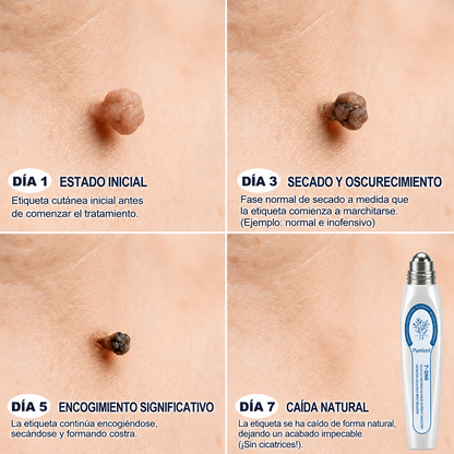 Tienda oficial de la marca | ✅💎 Purelora® Borrador de verrugas y manchas de 7 días (Aplicador roll-on: sin dolor ni cicatrices)