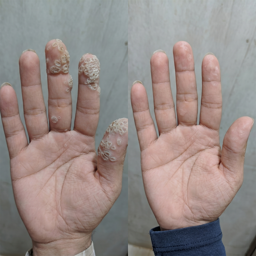 Soporte de belleza orgánico |✅💎 Purelora® Rollo de cuidado hidrocoloide 6 en 1: cuidado del acné, control de la grasa, marcas posteriores a imperfecciones, cuidado de cicatrices, protección visible contra manchas y cuidado de los poros.