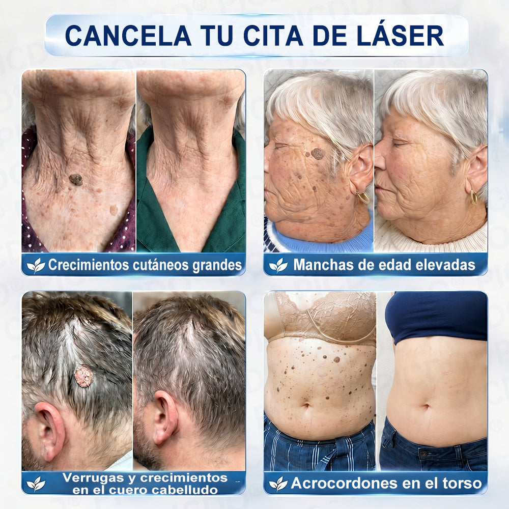 Crema PURELORA® para eliminar verrugas cutáneas e imperfecciones en 7 días (fórmula indolora, sin cicatrices) 🌹🌹