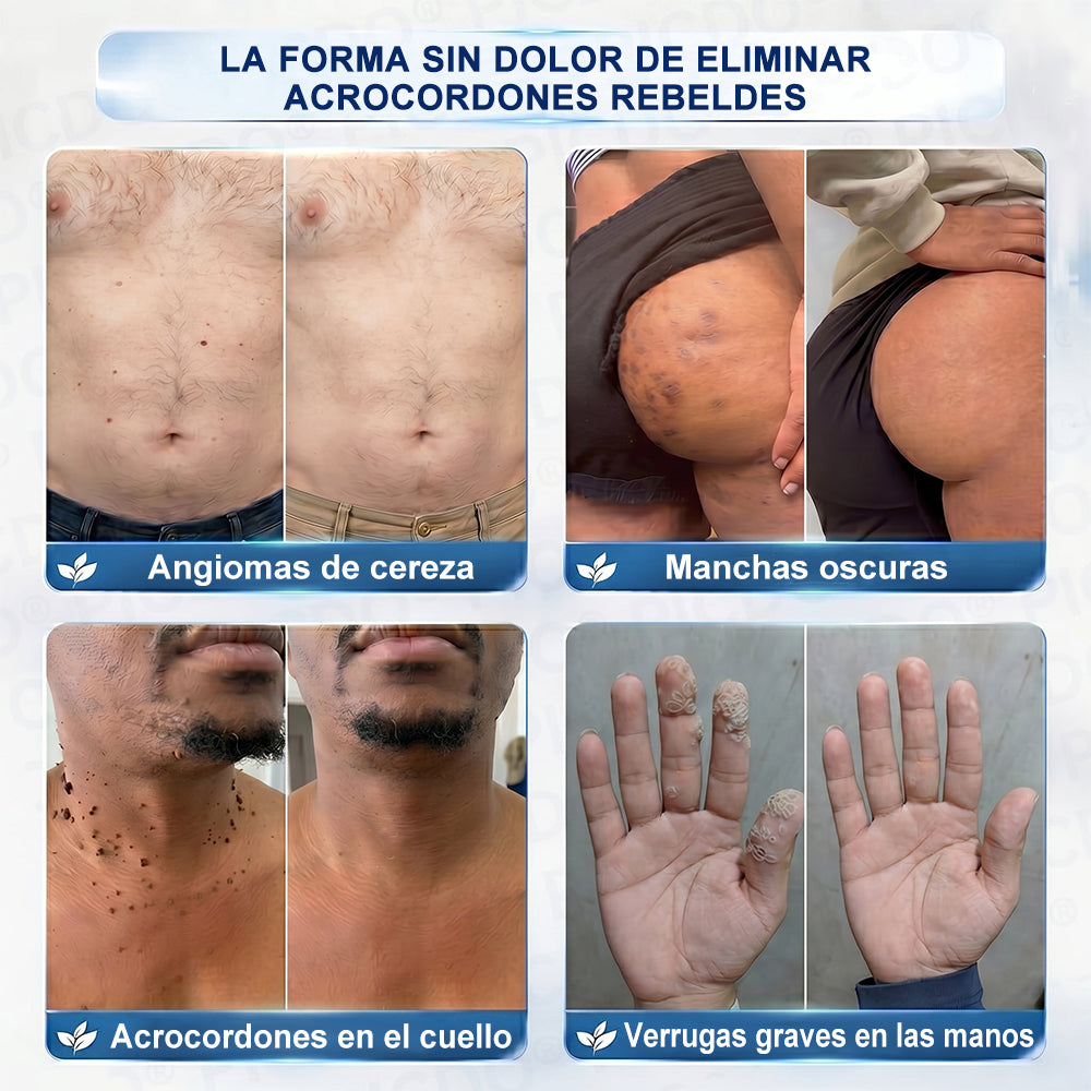 Crema PURELORA® para eliminar verrugas cutáneas e imperfecciones en 7 días (fórmula indolora, sin cicatrices) 🌹🌹