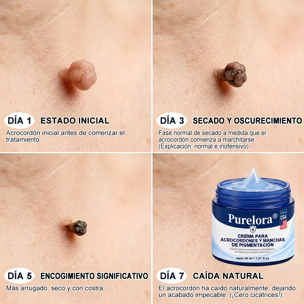 Crema PURELORA® para eliminar verrugas cutáneas e imperfecciones en 7 días (fórmula indolora, sin cicatrices) 🌹🌹
