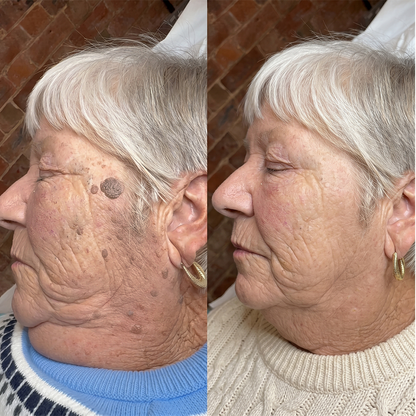 Soporte de belleza orgánico |✅💎 Purelora® Rollo de cuidado hidrocoloide 6 en 1: cuidado del acné, control de la grasa, marcas posteriores a imperfecciones, cuidado de cicatrices, protección visible contra manchas y cuidado de los poros.