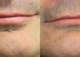 ✨Curalona® 2-in-1 Microneedle and Hydrocolloid Patch🍀 | Removes raised moles, acne, flat warts, and skin fibromas | Helps improve wrinkles, scars, and imperfections | Invisible patches for face and body