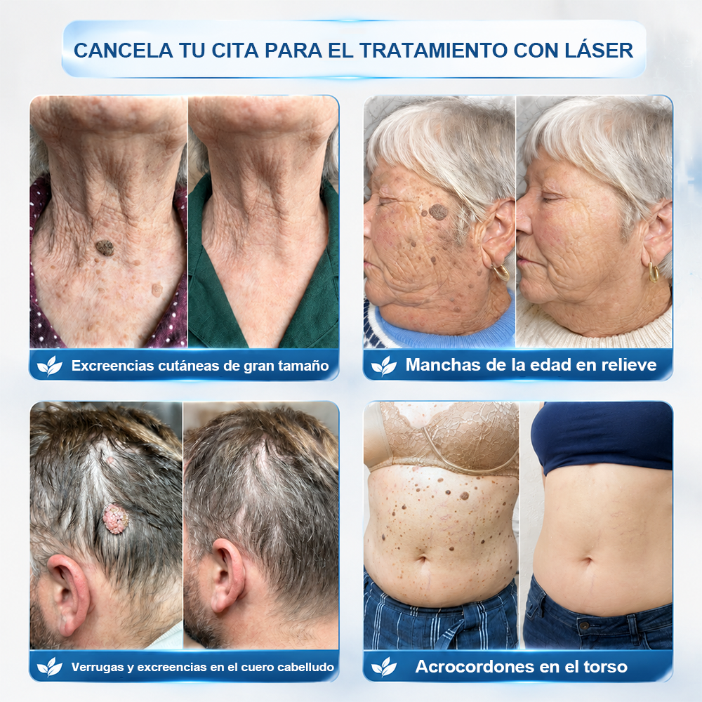 Tienda oficial de la marca | ✅💎 Purelora® Borrador de verrugas y manchas de 7 días (Aplicador roll-on: sin dolor ni cicatrices)