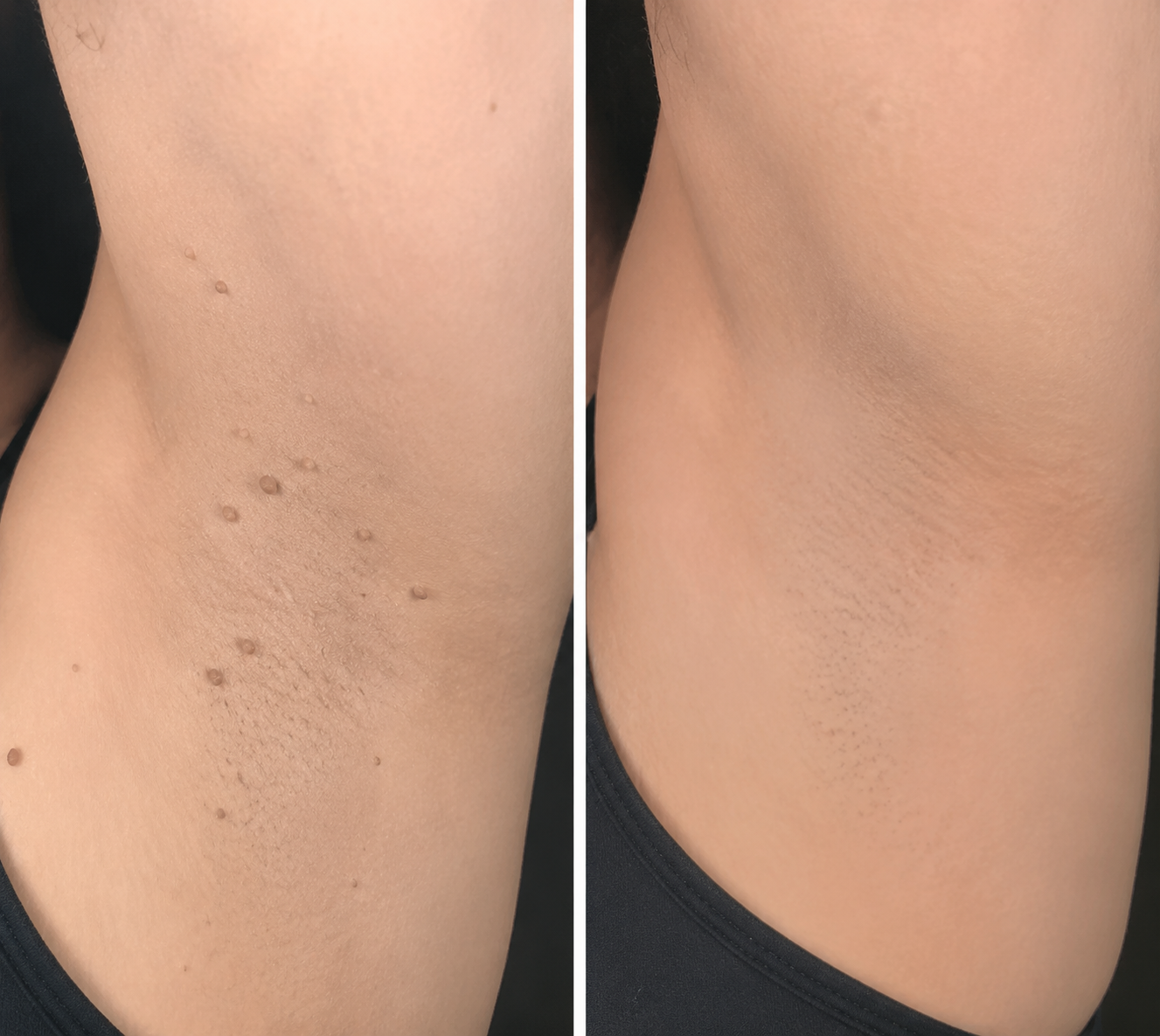 ✨Curalona® 2-in-1 Microneedle and Hydrocolloid Patch🍀 | Removes raised moles, acne, flat warts, and skin fibromas | Helps improve wrinkles, scars, and imperfections | Invisible patches for face and body