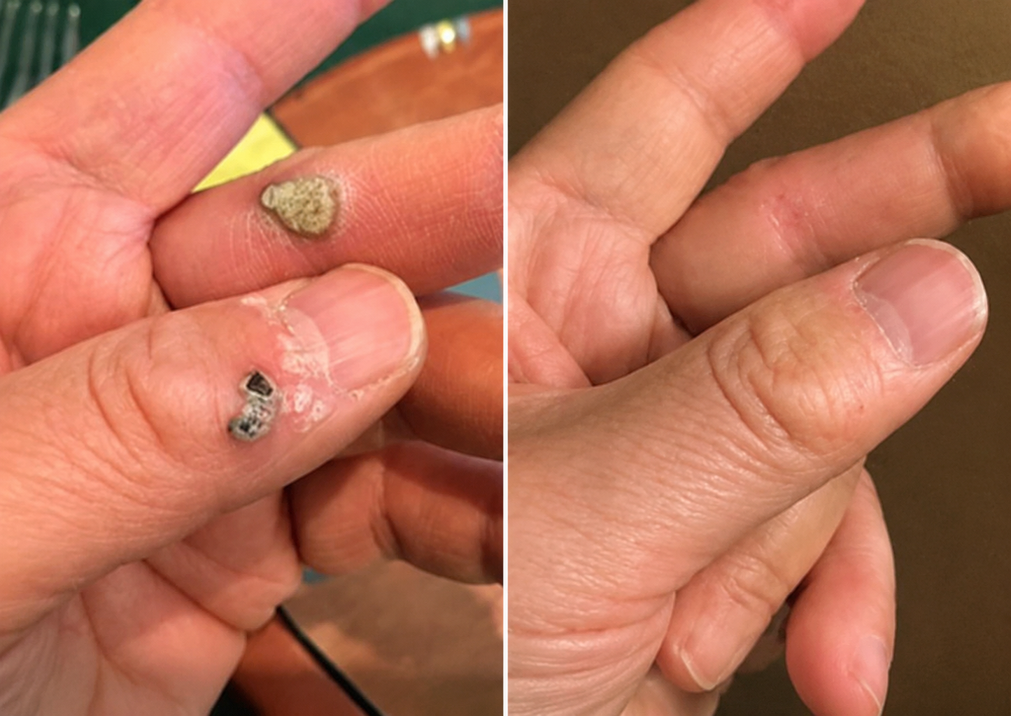 ✨Curalona® 2-in-1 Microneedle and Hydrocolloid Patch🍀 | Removes raised moles, acne, flat warts, and skin fibromas | Helps improve wrinkles, scars, and imperfections | Invisible patches for face and body